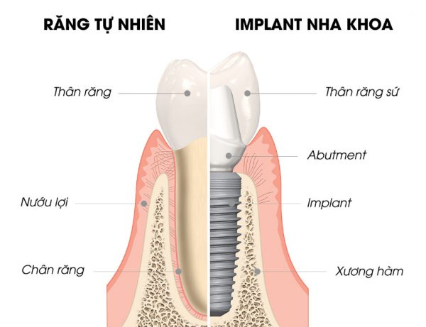 Cấy ghép implant thay thế răng mất trụ implant đặt vào vị trí chân răng thật