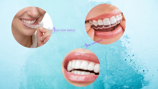 quy trình niềng răng trong suốt
