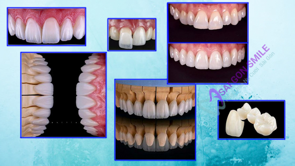 răng toàn sứ, răng sứ zicornia, răng sứ cercon, răng sứ Lava, răng sứ ngọc trai