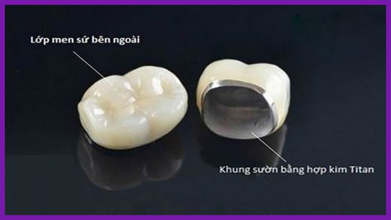 phân loại răng sứ kim loại