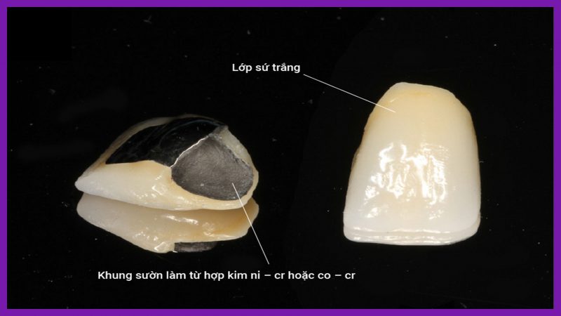 phân loại răng sứ kim loại