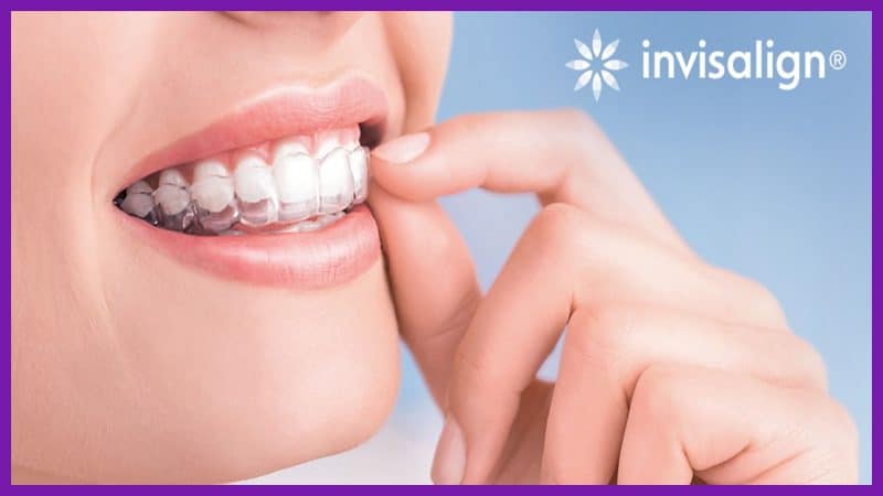 Niềng răng trong suốt invisalign