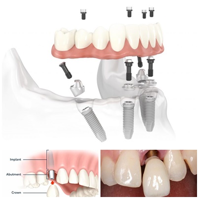 Trồng răng đặt trụ implant