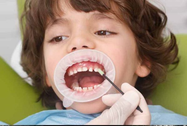 Bác sĩ tư vấn điều trị răng trẻ em phòng ngừa sâu răng