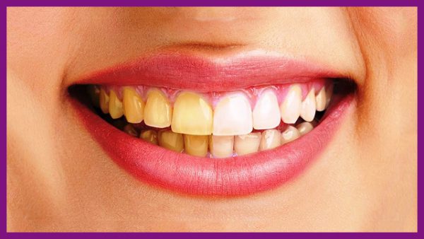 bọc răng sứ có ảnh hưởng tới sức khoẻ không