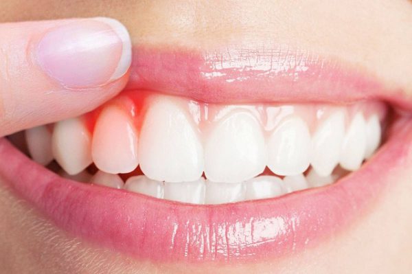 bọc răng sứ có ảnh hưởng tới sức khoẻ không