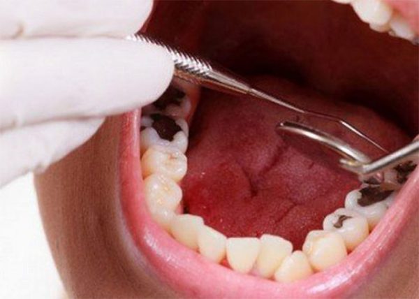 Bọc răng hàm bị sâu