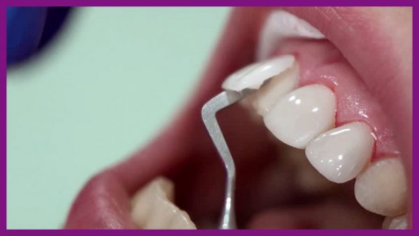 bọc răng sứ và những biến chứng khó lường