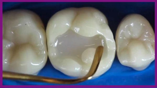Cầu răng sứ bị mẻ cần làm gì