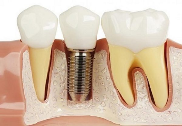 tư vấn dịch vụ cắm chân răng implant uy tín, chất lượng