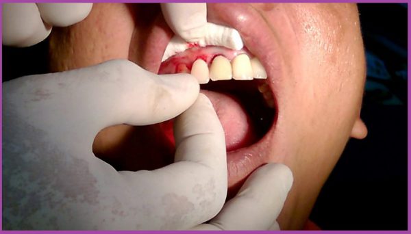 Kỹ thuật dán răng sứ khó hơn bọc răng sứ