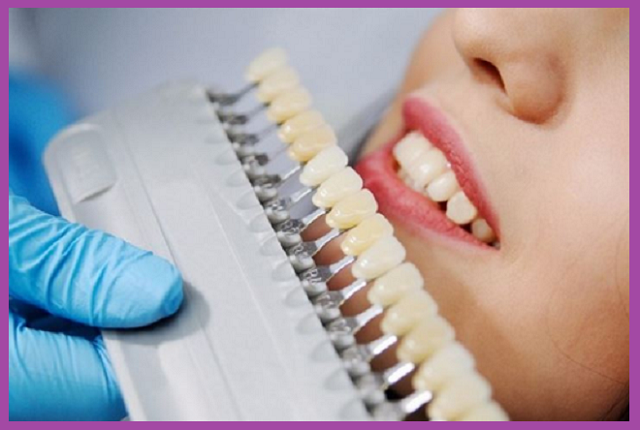 Dán răng Veneer giá bao nhiêu? Vì sao dán răng sứ đắt hơn bọc răng sứ?
