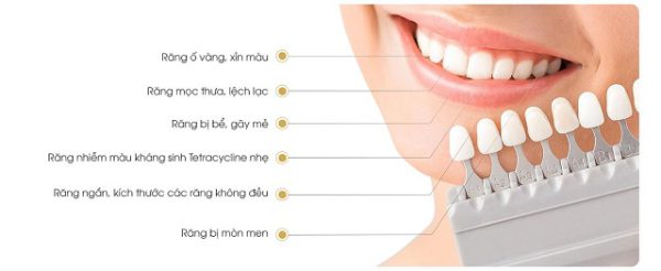 Dán sứ Veneer Emax