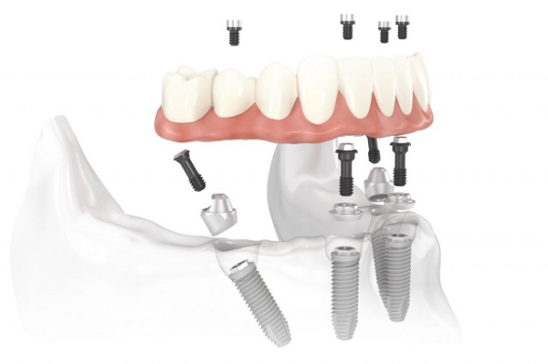 dịch vụ trồng răng implant all on 4 uy tín
