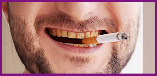 răng nhiễm tetra có tẩy trắng được không