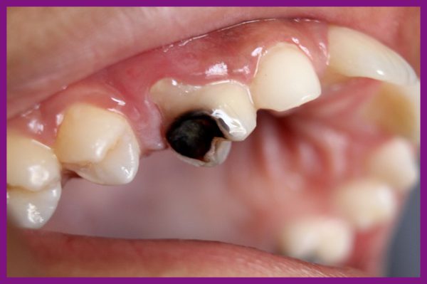 quy trình bọc răng sứ cho răng sâu