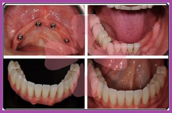 quy trình trồng răng implant all on 4