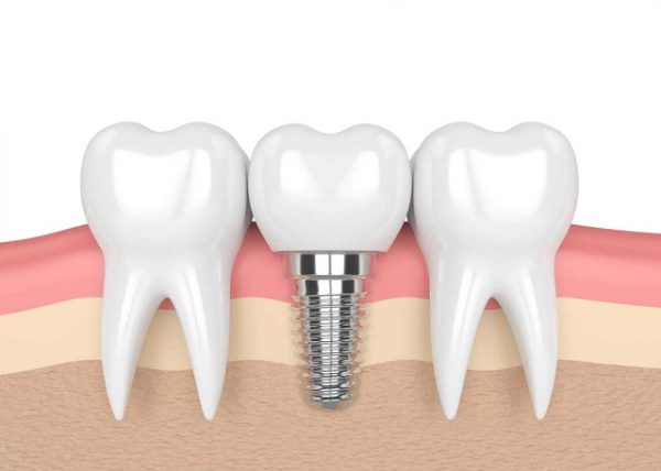 trồng răng implant all on 6