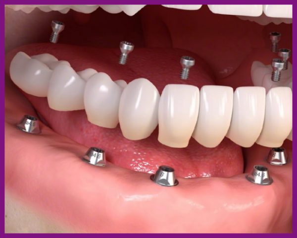trồng răng implant all on 6 đẹp