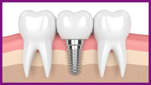 trồng răng implant có chụp mri được không?