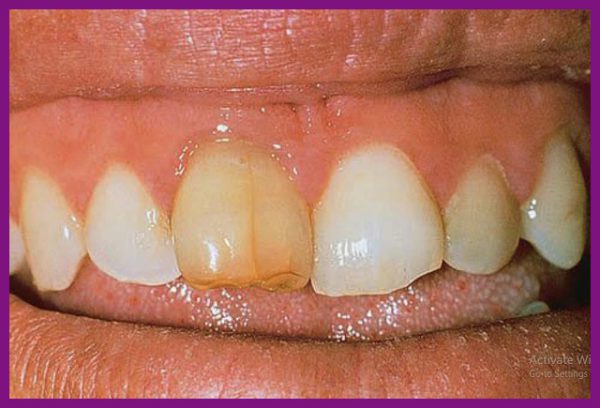 trồng răng sứ nguyên hàm