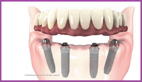 ưu điểm trồng răng implant all on 4