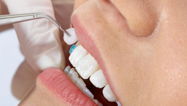 Loại xi măng nào thường được sử dụng để gắn răng sứ?
