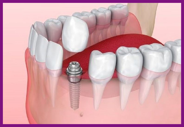 Cấy trụ răng Implant
