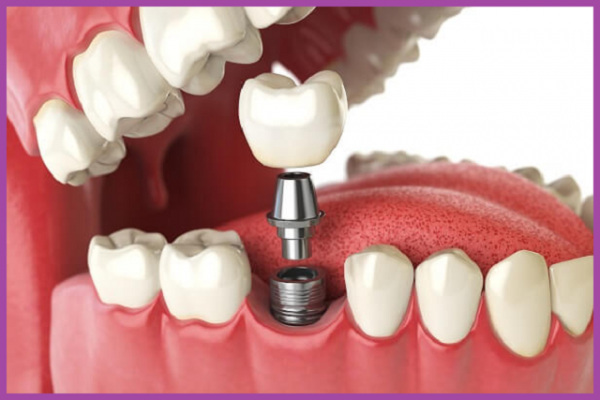 Kinh nghiệm trồng răng Implant gồm