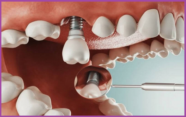 có kinh nghiệm trồng răng Implant 