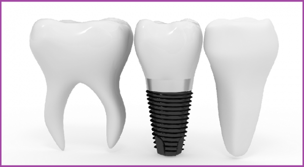 những kinh nghiệm trồng răng Implant 