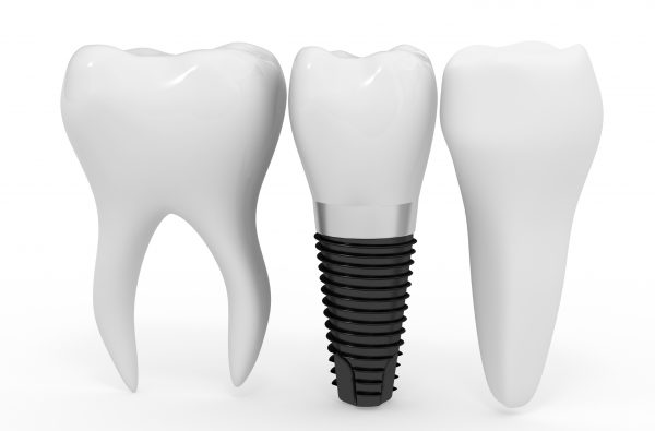 Kinh nghiệm trồng răng Implant