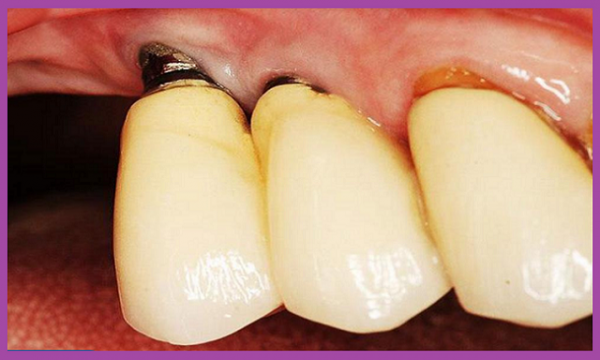 Răng bị nhiễm trùng sau implant do bác sĩ tay nghề còn non yếu