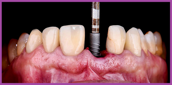 những biến chứng khi trồng răng Implant 
