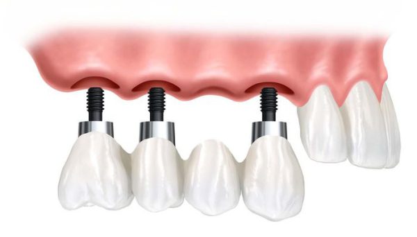 biến chứng khi trồng răng Implant