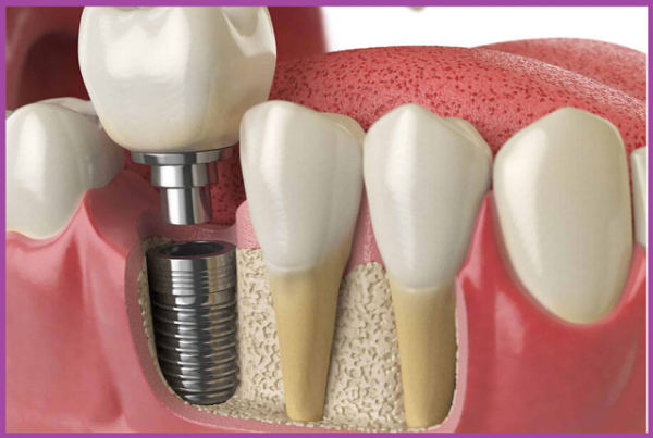 có nhiều biến chứng khi trồng răng Implant