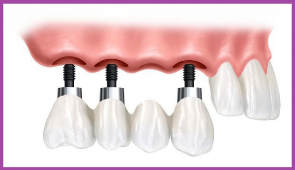 biến chứng khi trồng răng Implant b