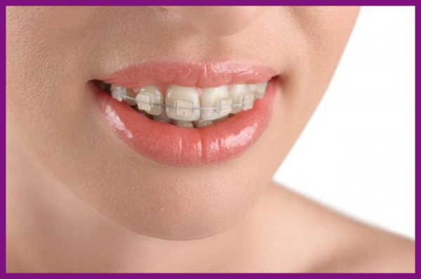 niềng răng khắc phục tình trạng răng bị hô móm, lệch khớp cắn