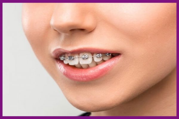 người bị răng hô nên dùng biện pháp niềng răng để đưa răng về đúng hướng