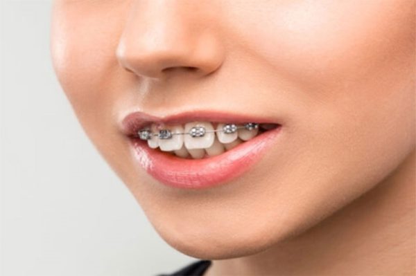 Các giai đoạn niềng răng hô chuẩn nha khoa bạn cần biết