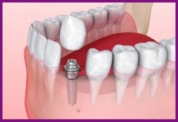 cấy ghép implant là phương pháp trồng răng hiệu quả và tối ưu nhất hiện nay