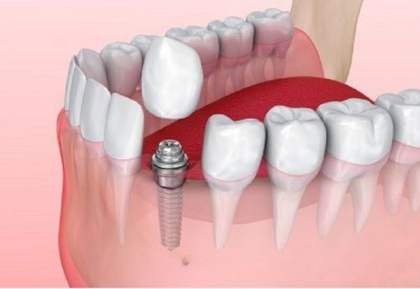 Tổng hợp kiến thức cần biết về cắm chân răng implant