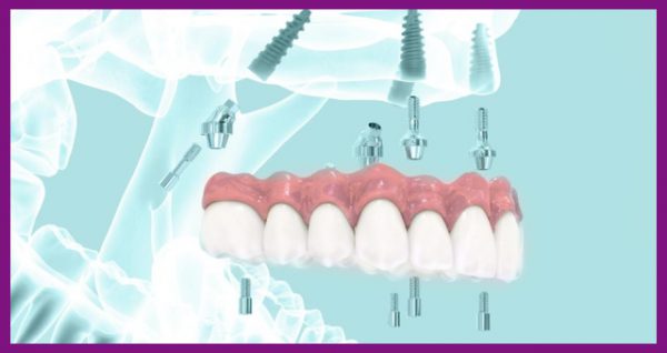 trồng răng implant thích hợp với nhiều người, kể cả những người mất răng toàn hàm