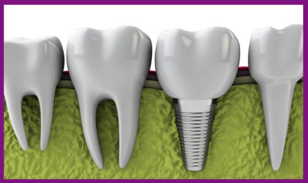 trồng răng implant là phương pháp phục hồi răng hiệu quả nhất hiện nay