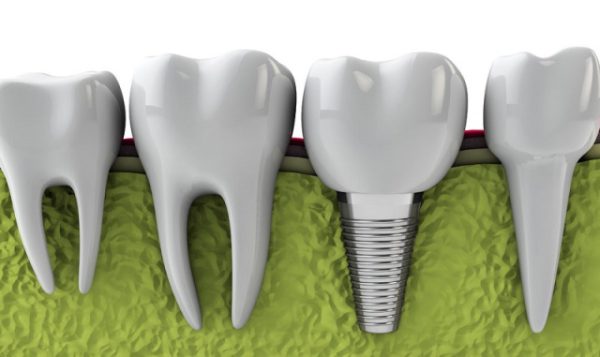 Cắm implant bị sưng và những giải pháp giảm sưng, đau nhanh chóng