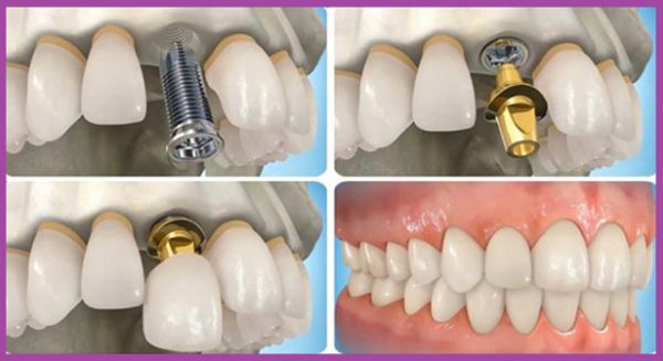 Cắm răng implant có thể bị đau do nhiễm trùng