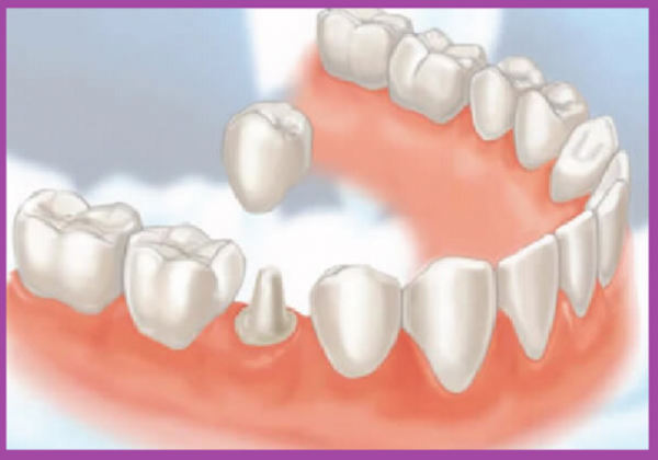 cầu răng sứ và implant a
