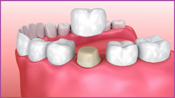 cầu răng sứ và implant f