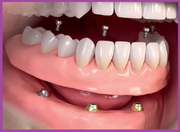 cầu răng sứ và implant d