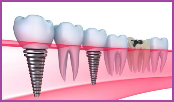 cầu răng sứ và implant e
